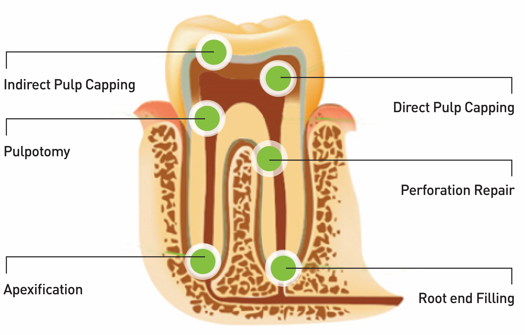 Indirect Pulp Capping | Direct Pulp Capping | Pulpotomy | Perforation Repair | Apexification | Root end Filling